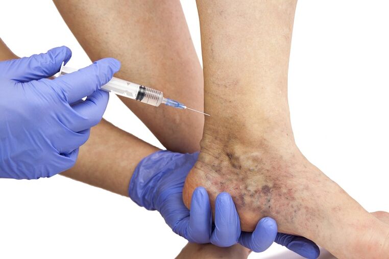 varicose vein injection